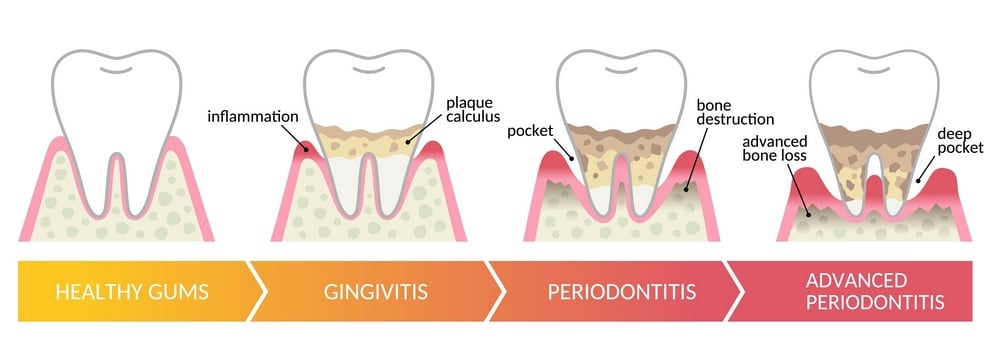 Diagram showing periodontal pocket and gum inflammation