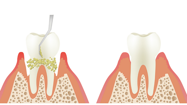 SCALING & ROOT PLANING