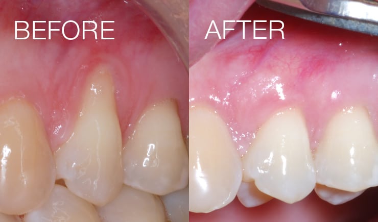 Soft-Tissue-Grafting