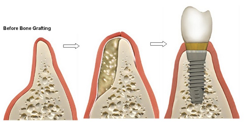 bone-grafting