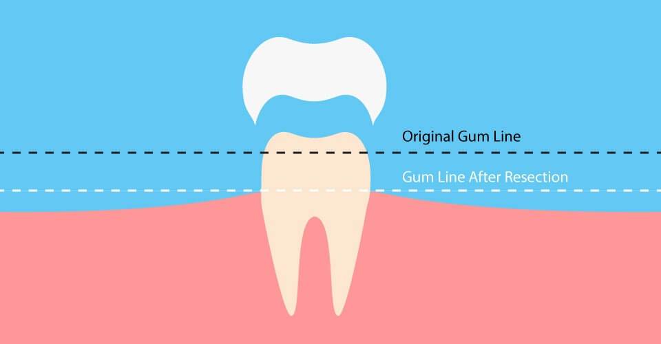 crown-lengthening-El Cajon