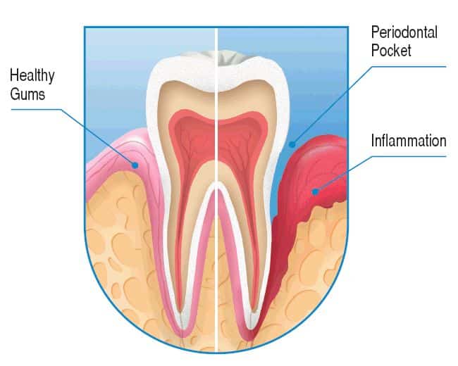 periodontal-disease