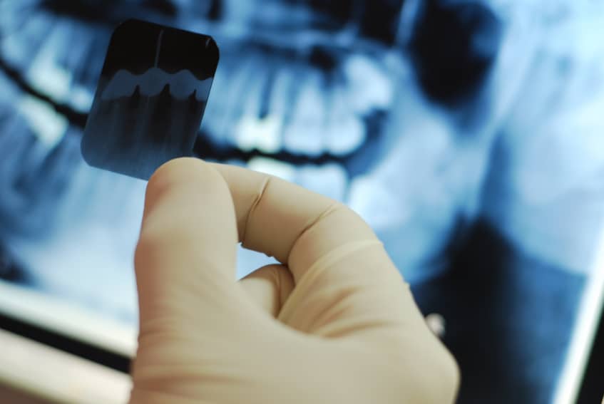 Dental-X-rays
