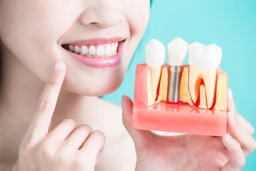 How To Keep Your Dental Implants from Failing?