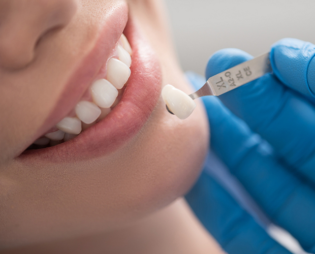 veneers