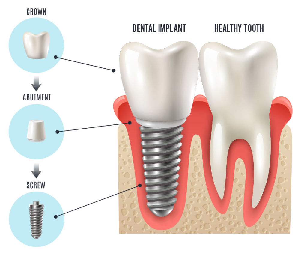 Structure of the Dental Implant