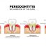 What is the difference between gingivitis and periodontitis