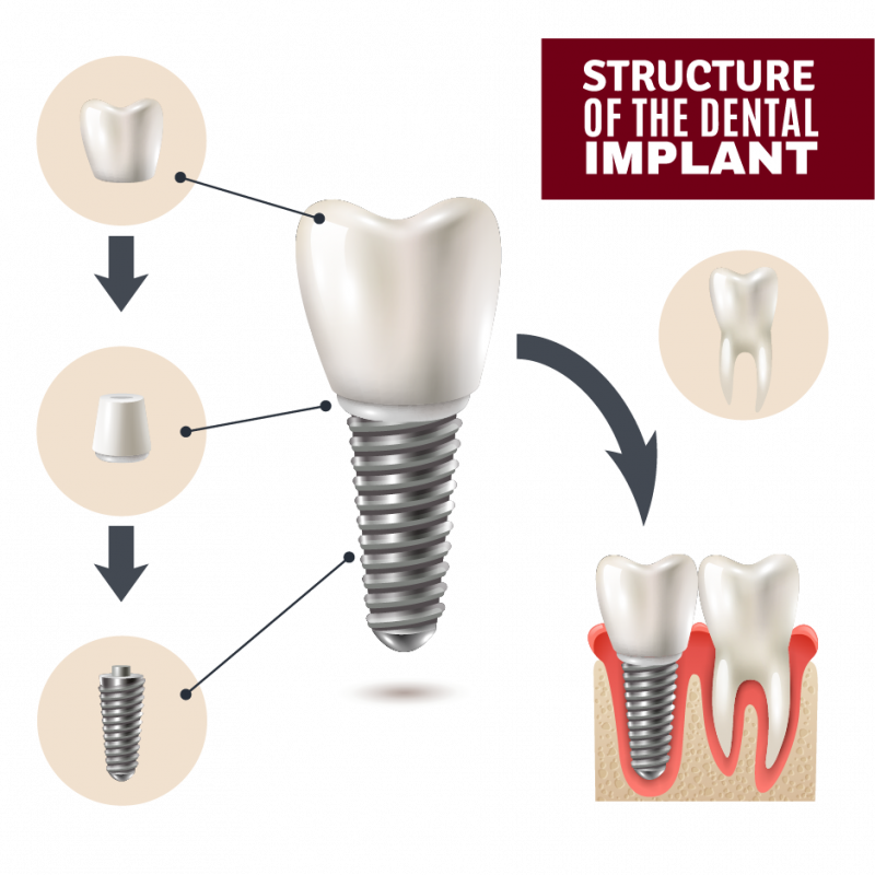 Dental Implant Quiz Dental Arts San Diego