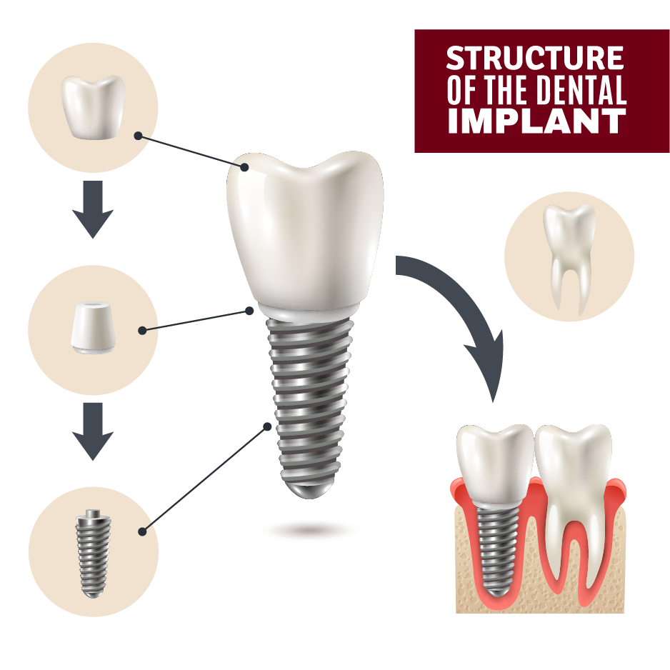 Implants-01