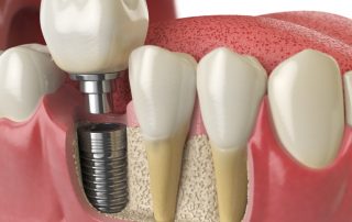 San Diego Dental Implant Facts