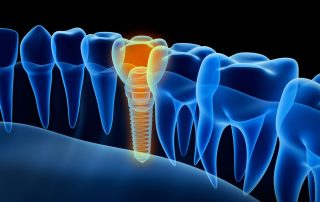 X-ray view of Dental Implant