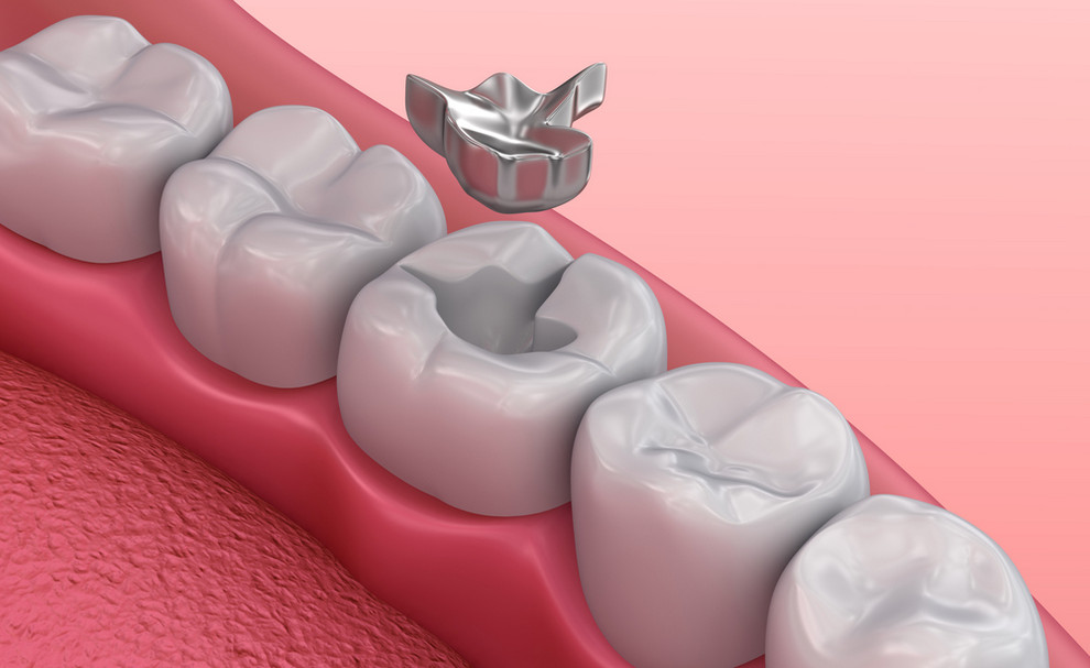 3D illustration of dental filling - What to Do if Your Filling Fell Out