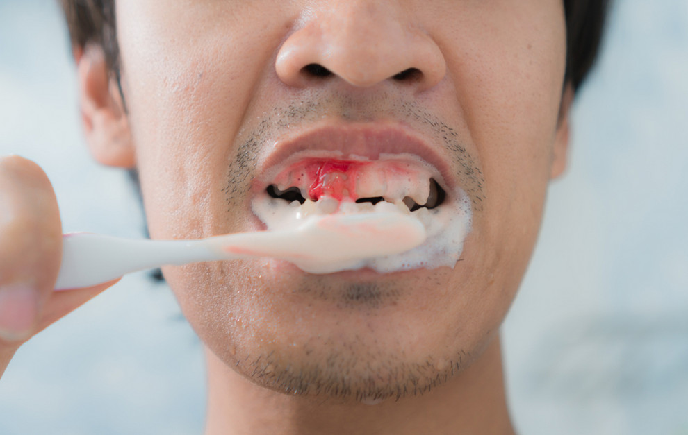 Bleeding gums from brushing teeth