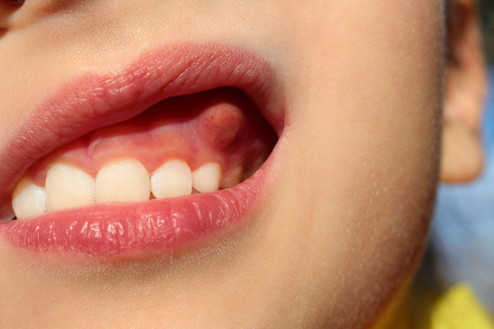 Can Tooth Decay Cause Tongue Sores