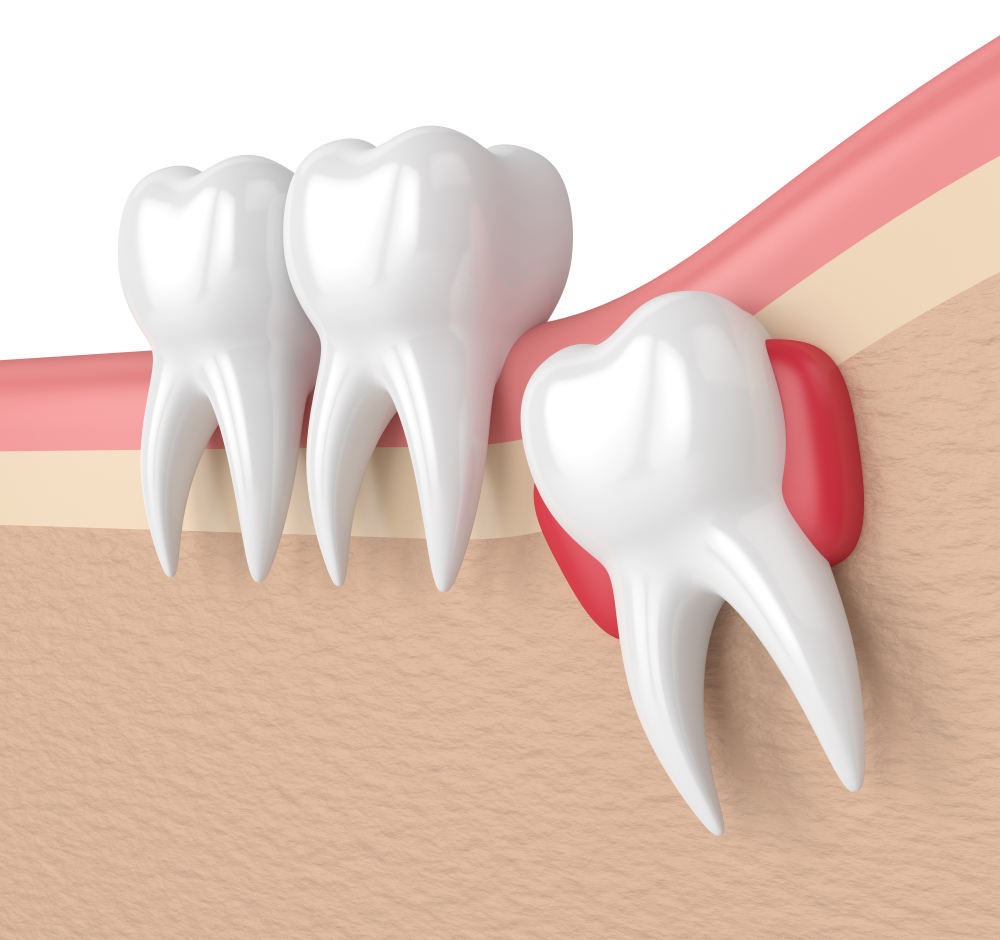 Inflammation Around the Gums