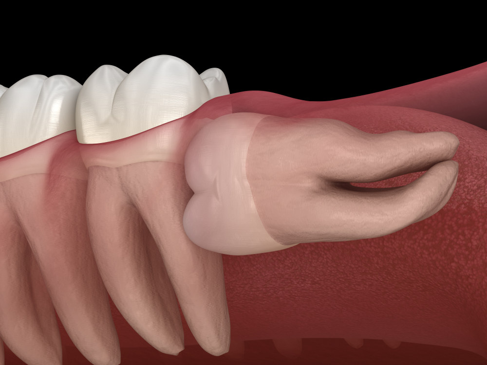 wisdom tooth impacting teeth (Common Signs You Need to Get Wisdom Teeth Removed)