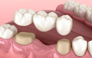 Dental Bridges (An Overview of Dental Bridges For Replacing Missing Teeth)