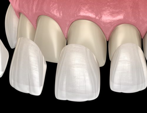 Could Dental Veneers be right for you?