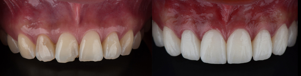dental veneer before and after