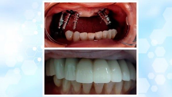 Smile Restoration with Upper Jaw Implants