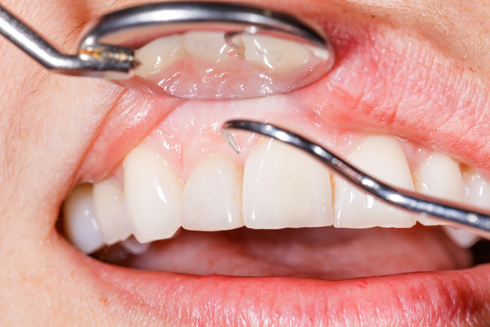 ﻿Treating Gum Disease: ﻿What Can You Expect