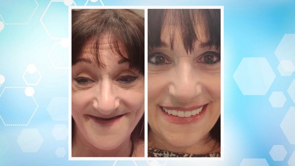 recent full mouth restoration patients