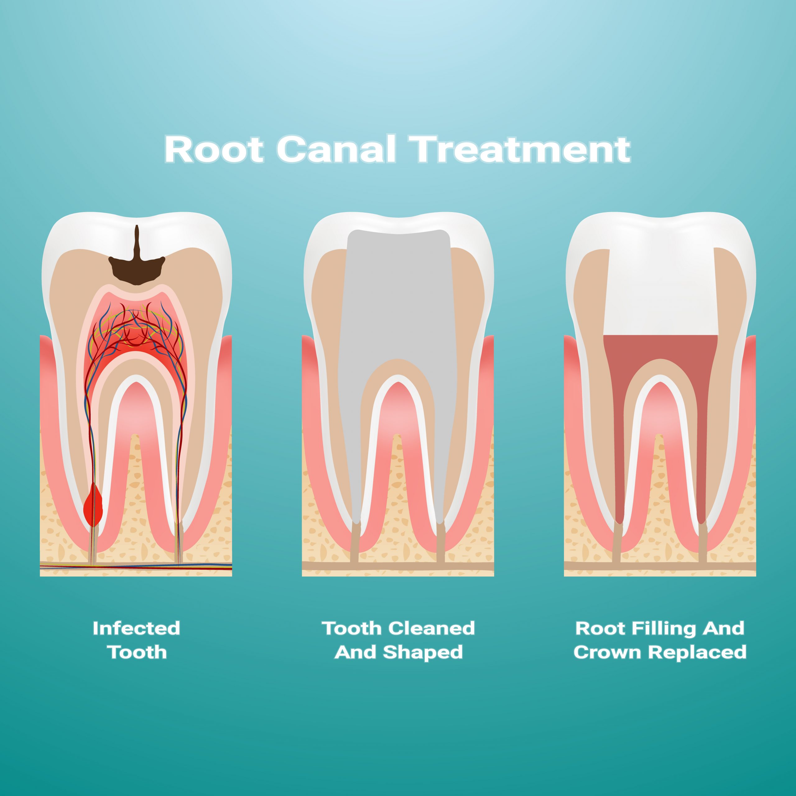 Pulpitis.,Root,Canal,Therapy.,Infected,Pulp,Is,Removed,From,The
