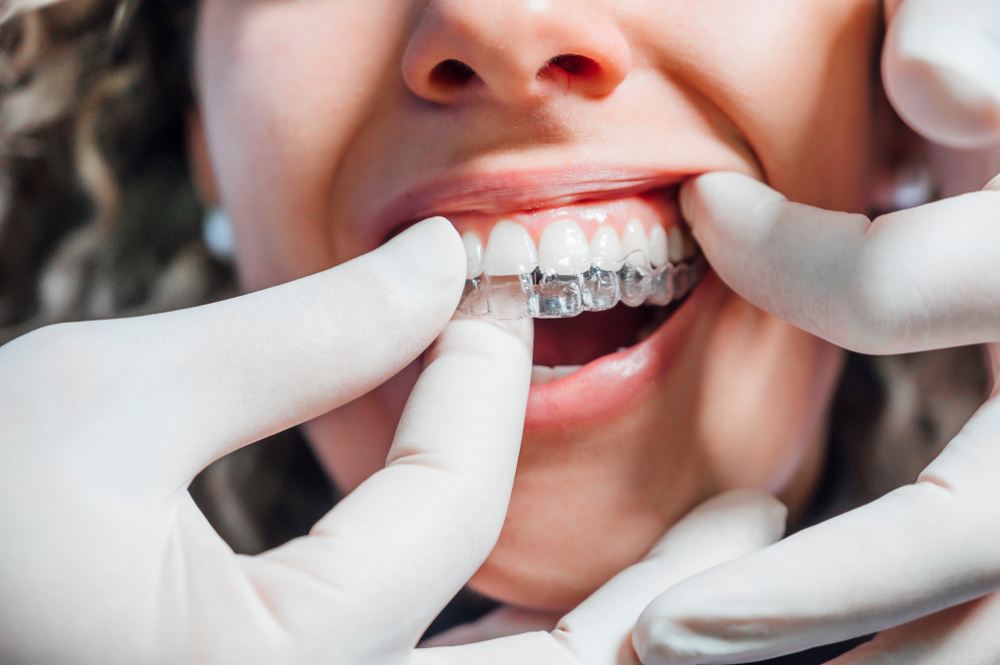 Invisalign, How Long It Takes to Work, and The Benefits.