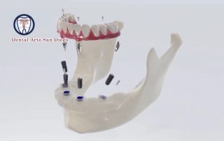 Can Implants be used with Dentures