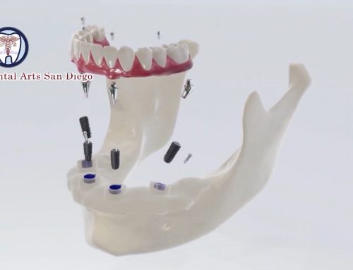 Can Implants be used with Dentures?
