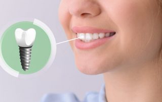 What is an actual dental implant?