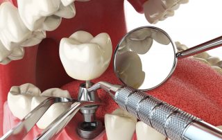 Your Questions About Dental Implants Answered