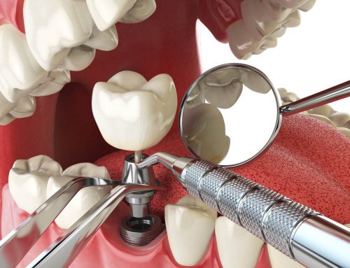 Your Questions About Dental Implants Answered