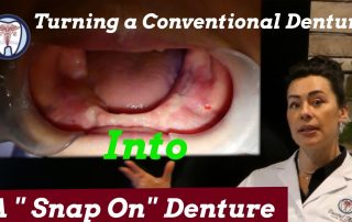 Turning a Conventional Denture Into a Snap On Denture