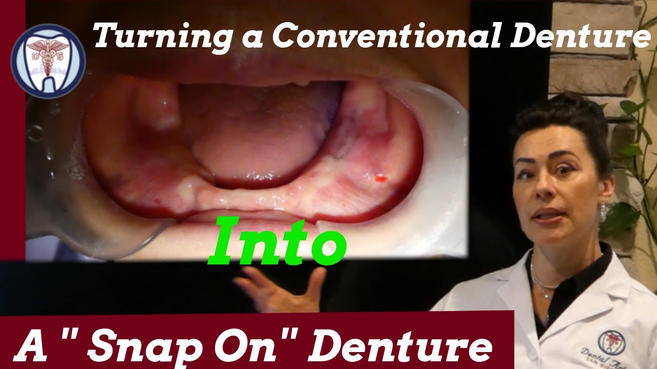 Turning a Conventional Denture Into a Snap On Denture