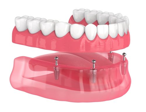 Can Implants be Used with Dentures?