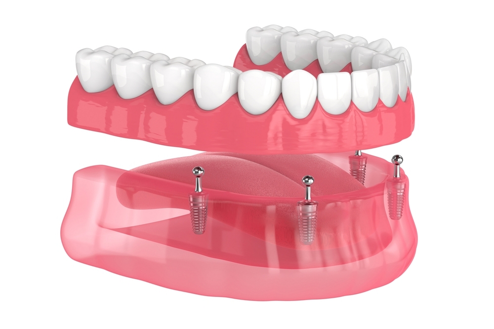 Implant-Supported Dentures - Can Implants be Used with Dentures