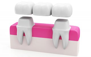 Caring for Your Dental Bridge: Maintenance Tips for a Long-Lasting Smile