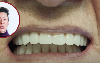 Benefits Of Snap-On Dentures