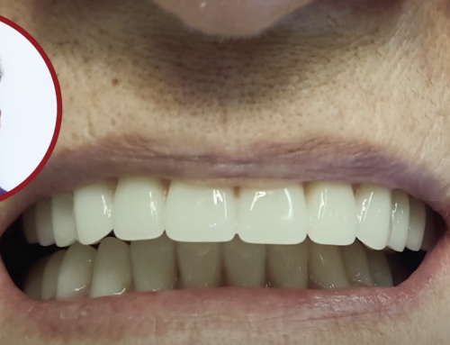 Benefits Of Snap-On Dentures