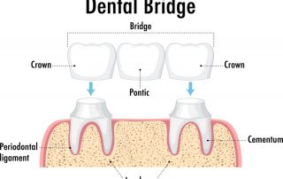 Dental Bridges and Their Purpose