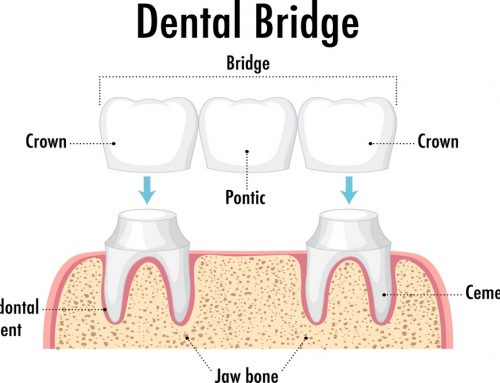 Bridging the Gap: An Introduction to Dental Bridges and Their Purpose