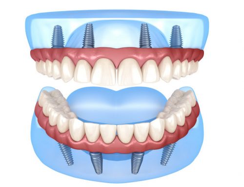 Full Mouth Dental Implants: Restoring Your Smile and Confidence