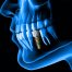 Are Dental Implants Painful