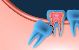 The Importance of Wisdom Teeth Removal