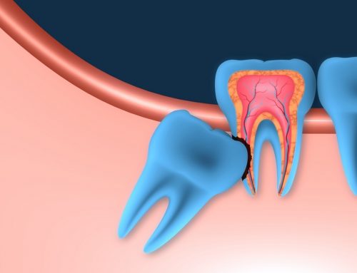The Importance of Wisdom Teeth Removal