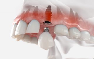 Risks Associated With Implants or Implant Process