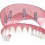 All-on-4 Zirconia Arches at Dental Arts San Diego