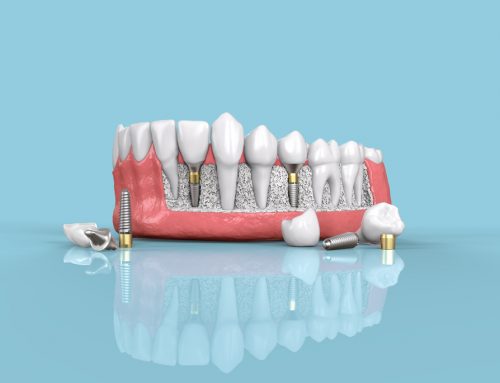 The Benefits of Dental Implants Over Traditional Dentures