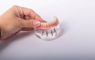 How Many Teeth Do You Get with All-on-4 Dental Implants?